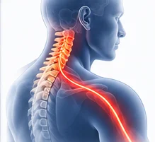 Hernia discal cervical