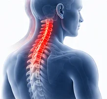 Mielopatía espondilótica cervical